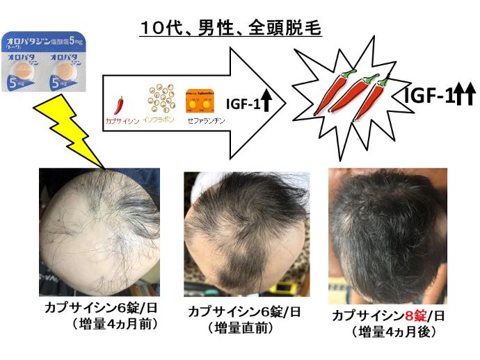 円形脱毛症　病院